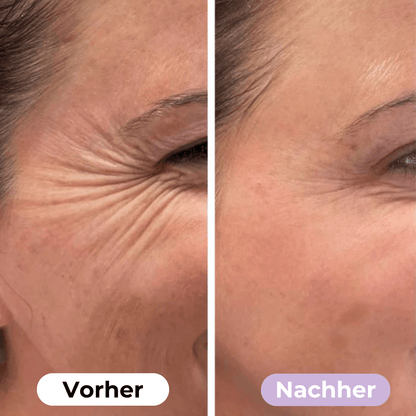 ScarRelief™ | Silikon-Narbenpflaster gegen Falten