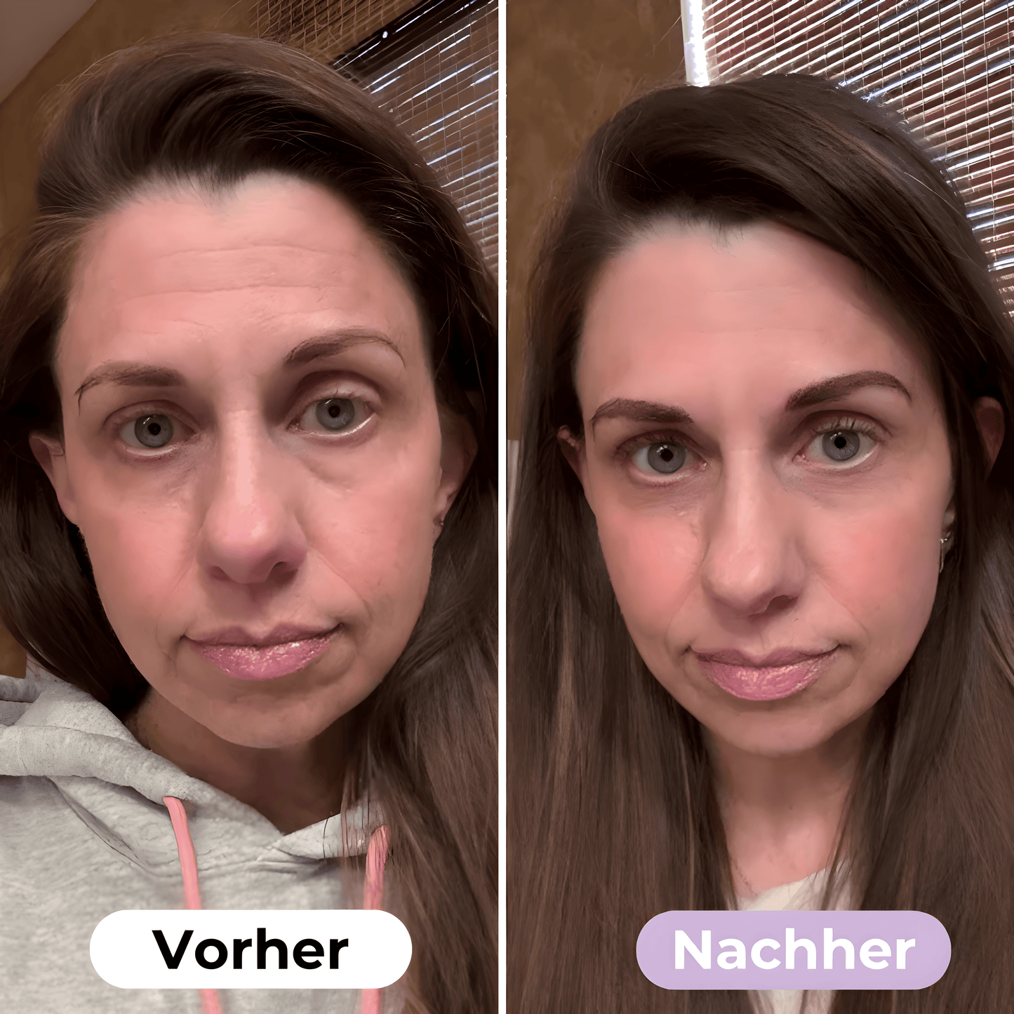 ScarRelief™ | Silikon-Narbenpflaster gegen Falten