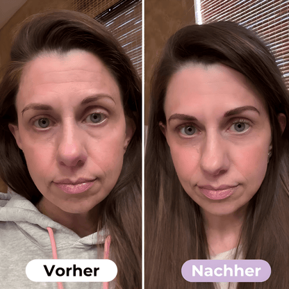 ScarRelief™ | Silikon-Narbenpflaster gegen Falten