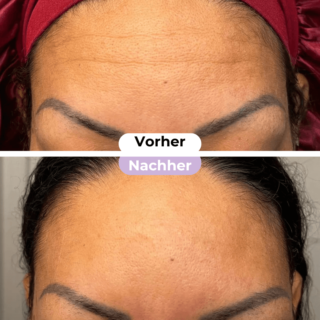 ScarRelief™ | Silikon-Narbenpflaster gegen Falten