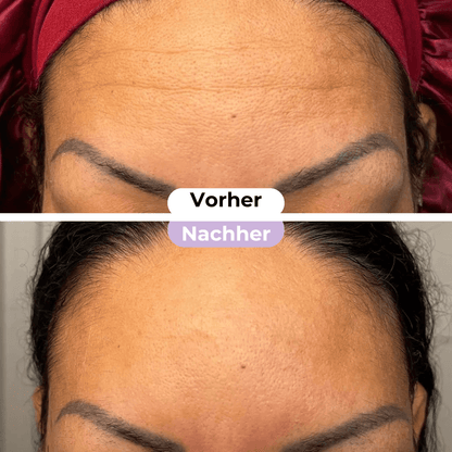 ScarRelief™ | Silikon-Narbenpflaster gegen Falten